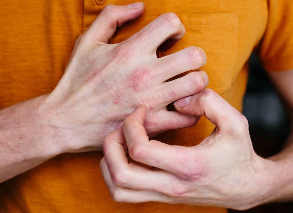 Benefits Of Summer Eczema Flares